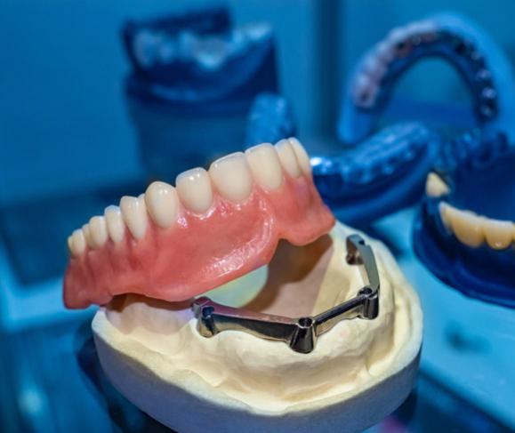 Soins dentaires à Nice - Traitement de caries, pose de couronnes